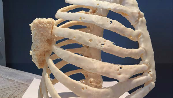 3D打印可改善胸壁肿瘤治疗效果